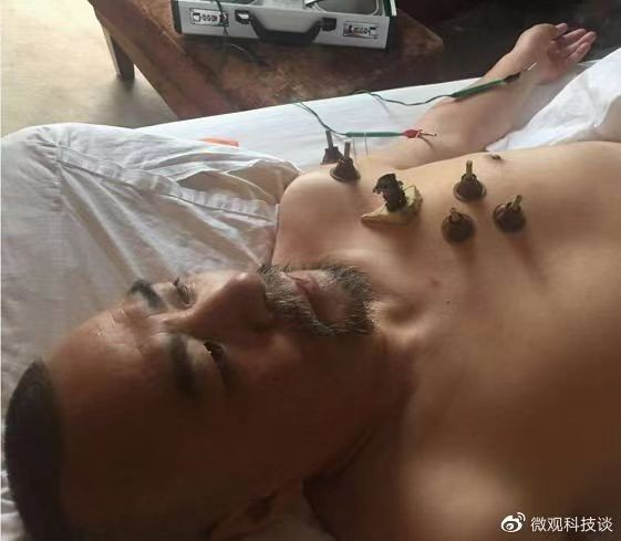 宁海中医徐友江 突破世界疑难症——美尼尔氏综合症